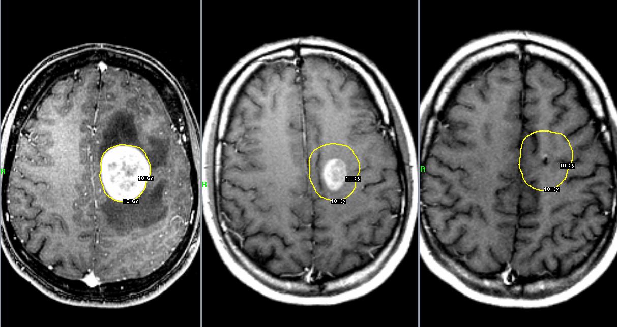Единичный метастаз лимфомы Ходжкина в головной мозг. Лечение на Гамма-ноже.